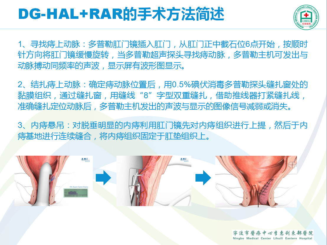 痔疮治疗新篇章：微创技术，轻松康复之旅